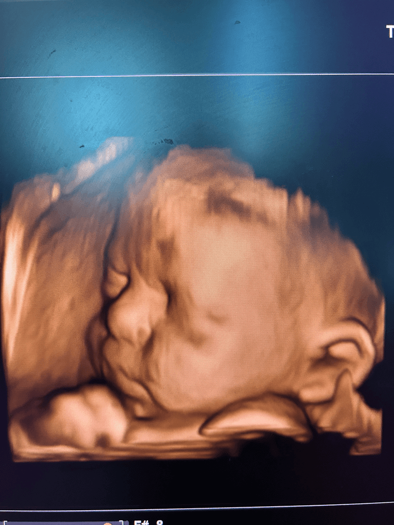 3D ultrasound image of a fetus showing facial features